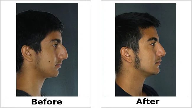 nose2.webp