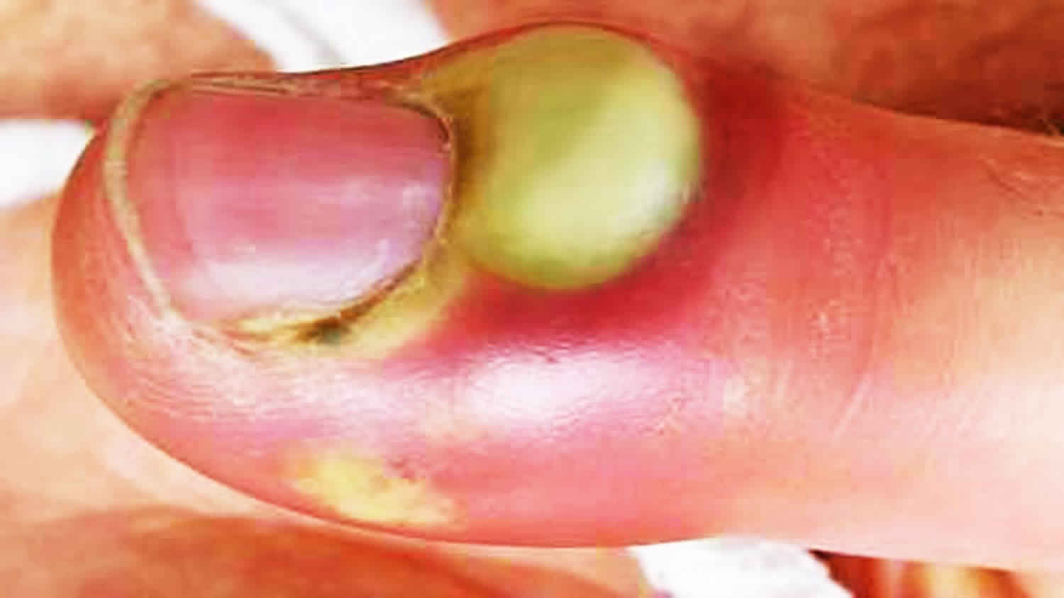 pus.jpg
