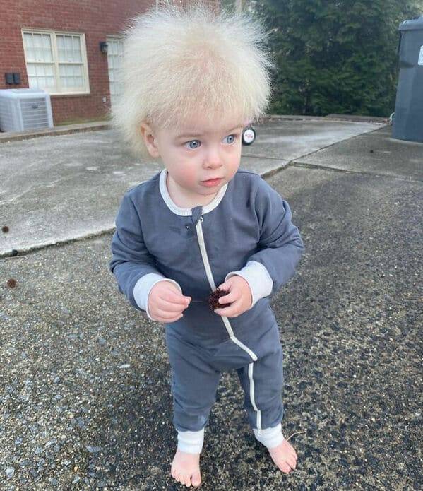 beautifully-unique-genetic-conditions-8.jpg